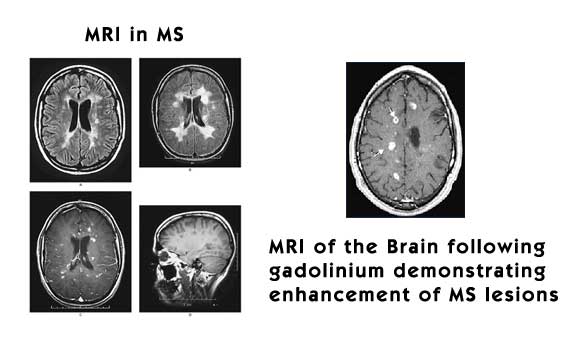 multiple sclerosis mri images. Multiple Sclerosis. MRI in MS