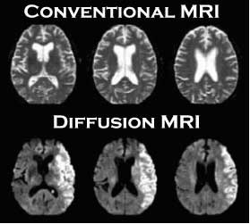 MRI showing stroke