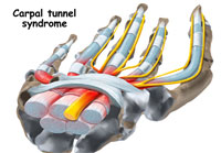carpal tunnel syndrome